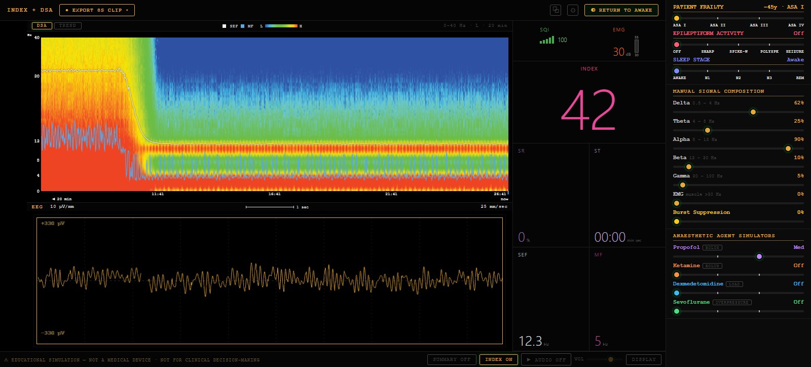 The Compact display at the same moderate-dose propofol. A single-panel density
                  spectral array fills the top of the monitor with the spectral edge and median
                  frequency traced over it, above a single-channel EEG at 25 mm/sec. A number
                  column to the right reads SQI 100, EMG 30 dB, Index 42 in large magenta numerals,
                  SR 0 %, ST 00:00, SEF 12.3 Hz and MF 5 Hz. The same control panel sits on the far
                  right with propofol at Med and all other agents off.