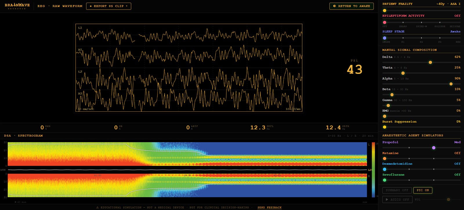 The Brainwave Neurosim display at moderate-dose propofol. Four channels of raw
                  EEG show large slow waves with superimposed alpha. The density spectral array
                  beneath runs left to right from a broadband red awake trace, through induction,
                  into a narrow red alpha and delta band with blue above it. Parameters read EMG
                  0%, suppression ratio 0%, artifact 0%, spectral edge 12.3 and 12.4 Hz, and the
                  depth index reads 43. The control panel on the right shows propofol at Med with
                  all other agents off.